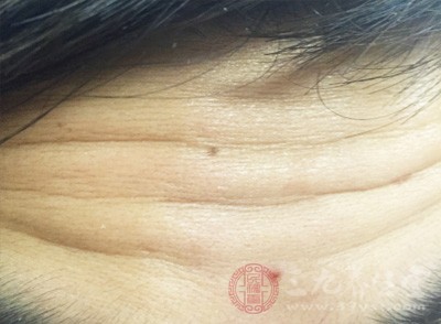 　去皱手术除皱可分为额部除皱术、颞部除皱术、全面部除皱术、全面颈部除皱术